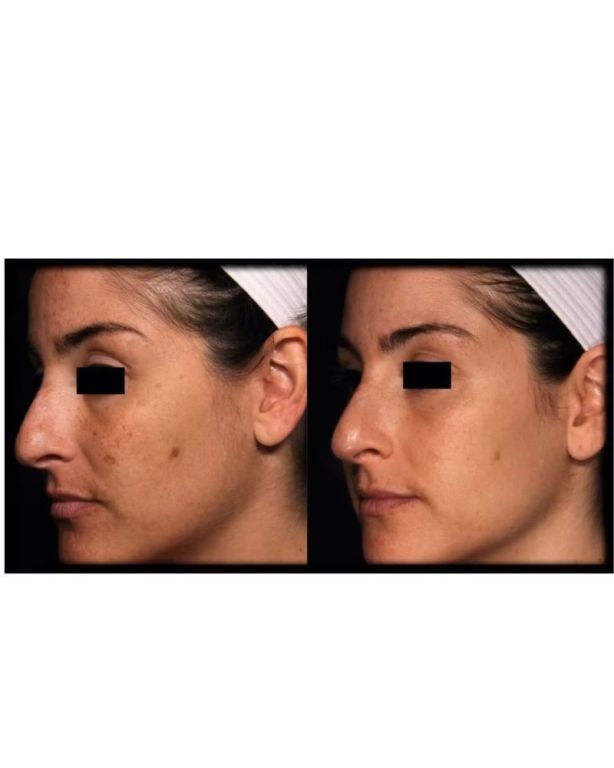 pico-skin-rejuvenation-big-0