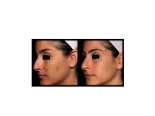 pico-skin-rejuvenation-small-0