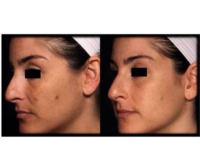 pico-skin-rejuvenation