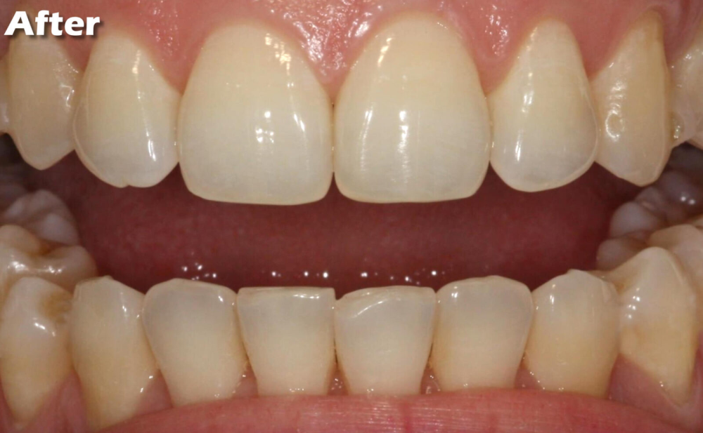 teeth-cleaning-services-dental-care-by-clarity-dental-big-0