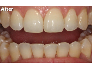 teeth-cleaning-services-dental-care-by-clarity-dental-small-0