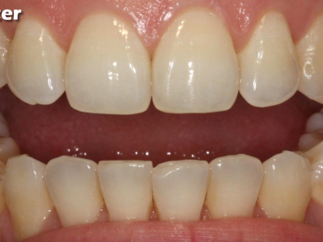 teeth-cleaning-services-dental-care-by-clarity-dental