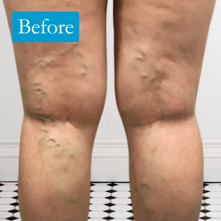 leg-vein-rescue-for-better-leg-vein-health-support-today-big-0