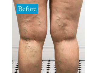 leg-vein-rescue-for-better-leg-vein-health-support-today-small-0