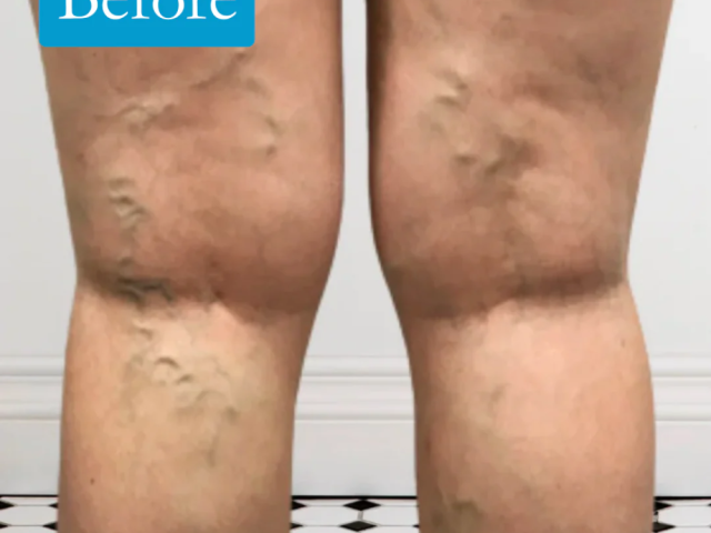 leg-vein-rescue-for-better-leg-vein-health-support-today