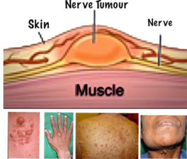 what-is-nf-understanding-neurofibromatosis-big-0
