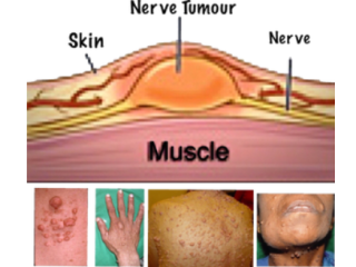 what-is-nf-understanding-neurofibromatosis-small-0