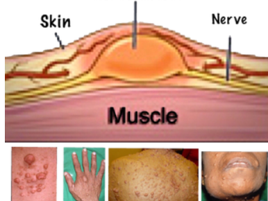 what-is-nf-understanding-neurofibromatosis