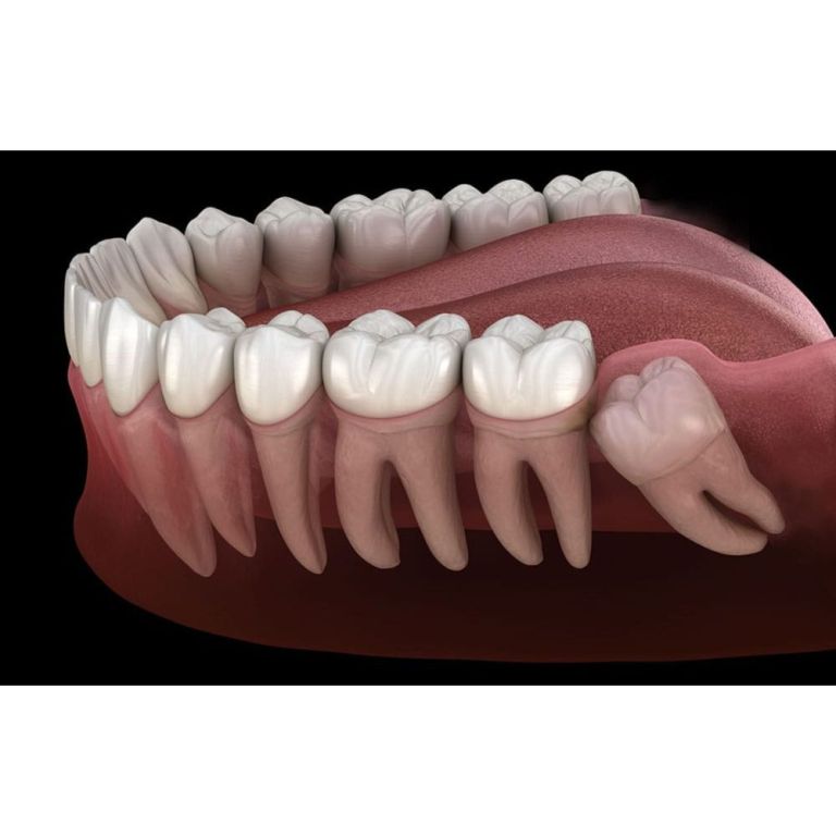 tooth-extraction-in-orangeville-big-0