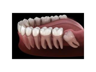 tooth-extraction-in-orangeville-small-0