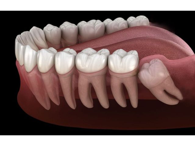 tooth-extraction-in-orangeville