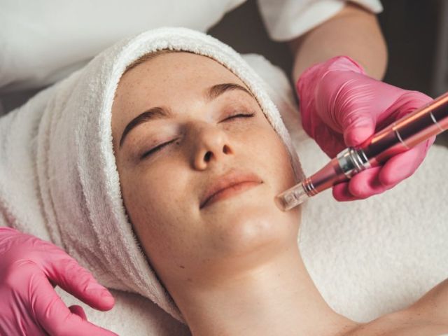 microneedling-surrey-for-acne-scars-fine-lines-book-today