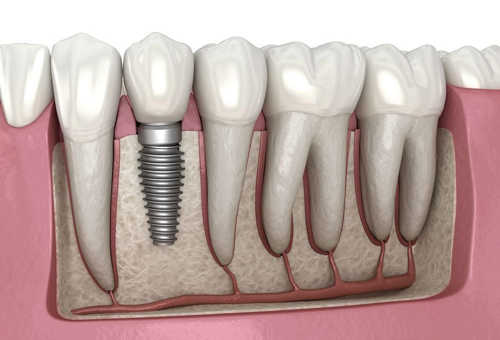 dental-implants-in-abbotsford-permanent-tooth-replacement-big-0