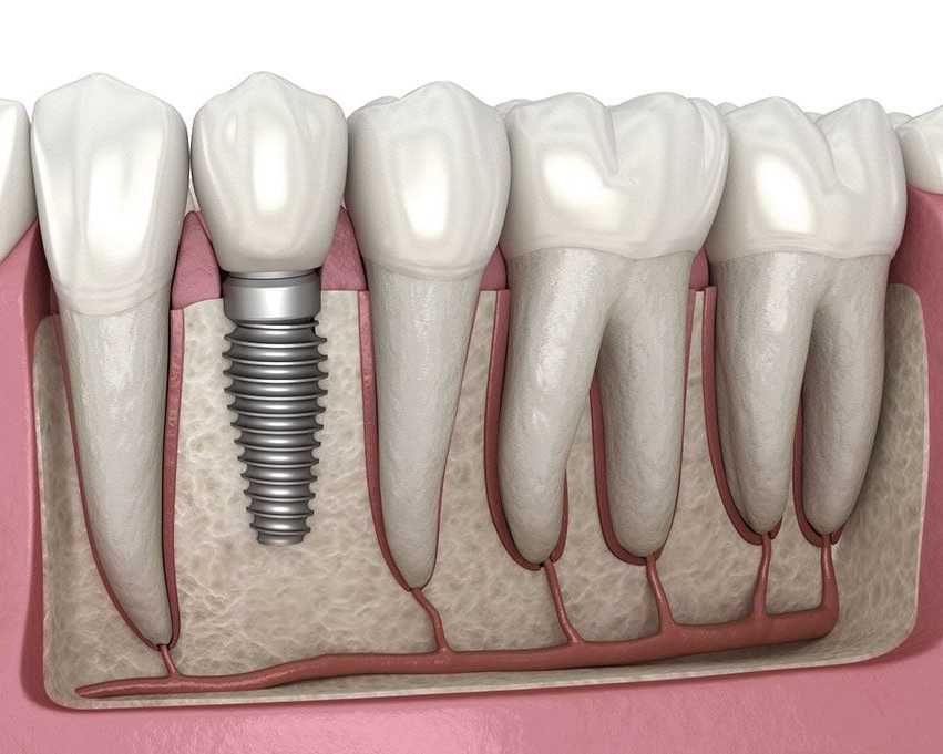 dental-implants-in-abbotsford-permanent-tooth-replacement