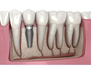 dental-implants-in-abbotsford-permanent-tooth-replacement-small-0