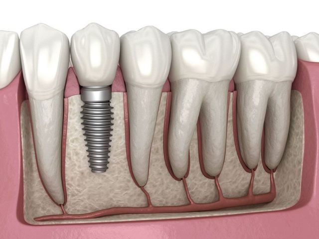 dental-implants-in-abbotsford-permanent-tooth-replacement