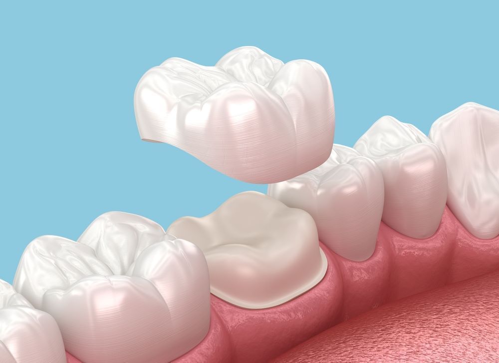 dental-crowns-in-abbotsford-restore-strength-beauty-big-0