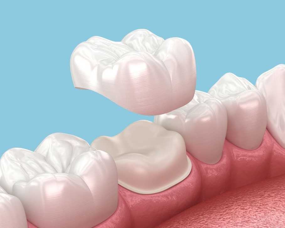 dental-crowns-in-abbotsford-restore-strength-beauty