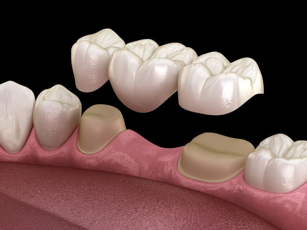 cracked-teeth-repair-in-abbotsford-emergency-dental-care-big-0