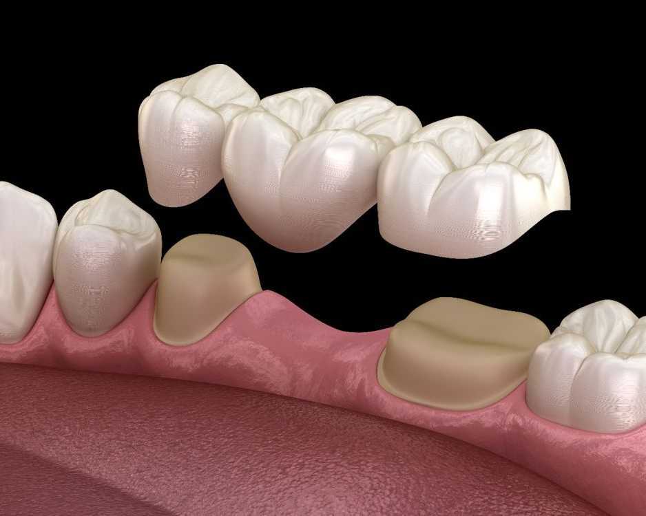 cracked-teeth-repair-in-abbotsford-emergency-dental-care