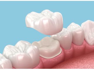 porcelain-veneers-in-abbotsford-transform-your-smile-small-0