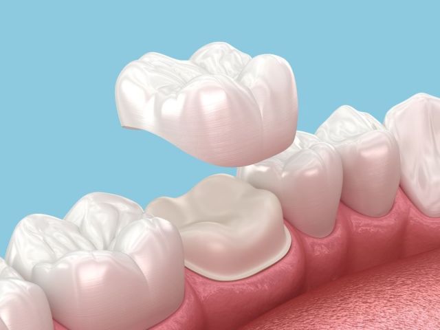 porcelain-veneers-in-abbotsford-transform-your-smile