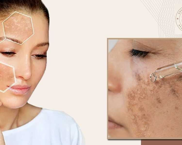 aafiyat-treatments-for-brightening-hyperpigmentation