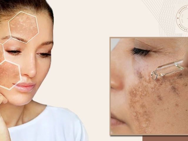 aafiyat-treatments-for-brightening-hyperpigmentation