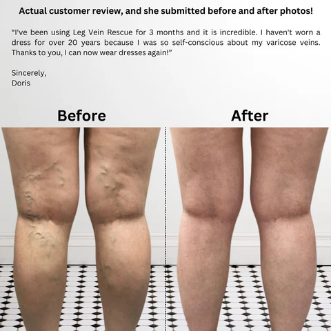 varicose-veins-treatment-for-healthy-legs-leg-vein-rescue-big-0
