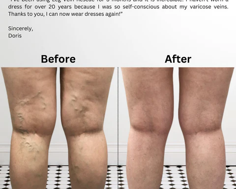 varicose-veins-treatment-for-healthy-legs-leg-vein-rescue