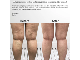 varicose-veins-treatment-for-healthy-legs-leg-vein-rescue-small-0