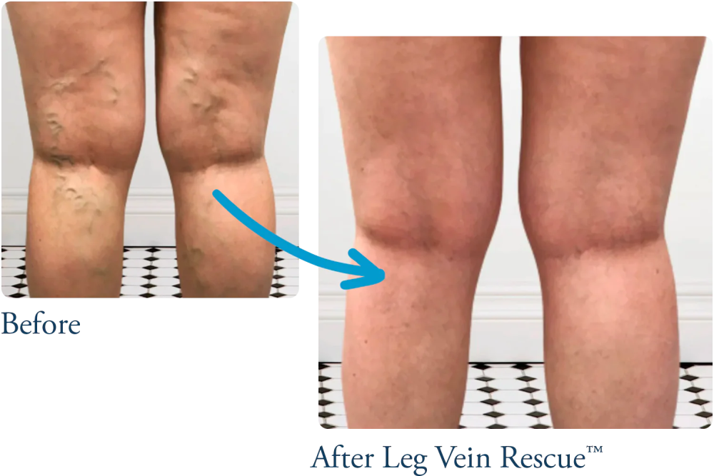 venous-insufficiency-treatment-care-leg-vein-rescue-big-0