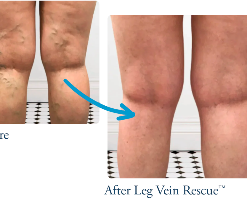 venous-insufficiency-treatment-care-leg-vein-rescue
