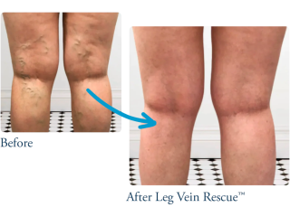 venous-insufficiency-treatment-care-leg-vein-rescue-small-0