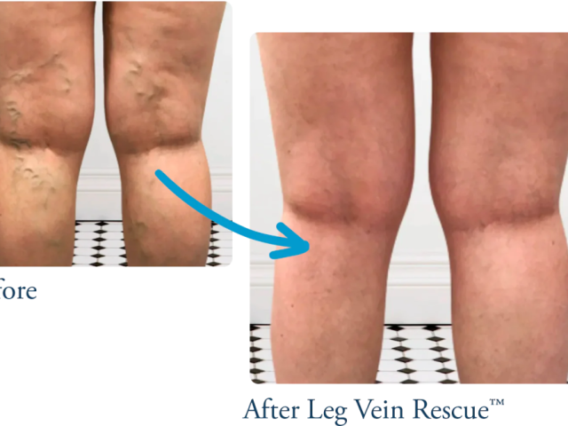 venous-insufficiency-treatment-care-leg-vein-rescue