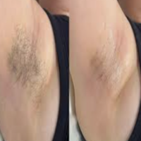 best-brazilian-waxing-in-edmonton-big-0