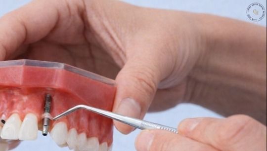 professional-dental-implant-treatment-for-missing-tooth-solutions-big-0