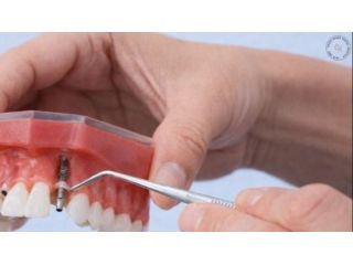 professional-dental-implant-treatment-for-missing-tooth-solutions-small-0