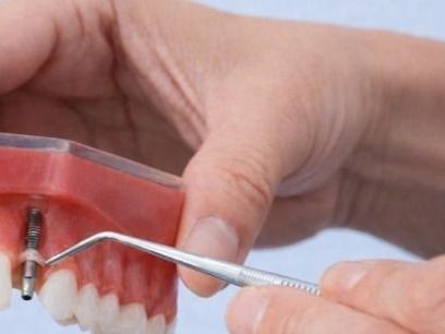 professional-dental-implant-treatment-for-missing-tooth-solutions