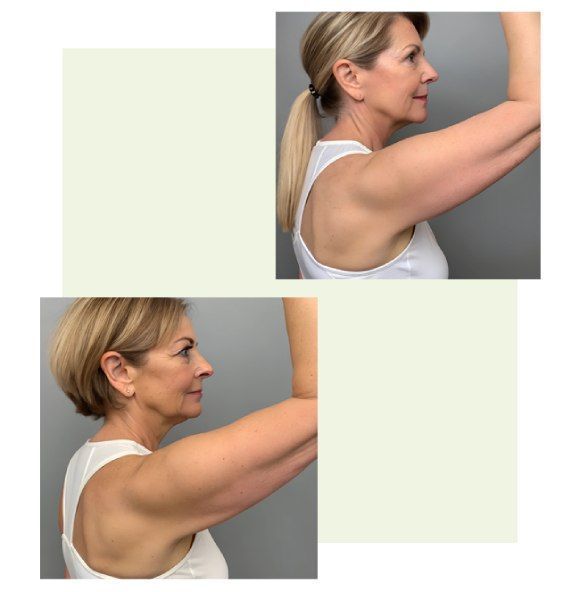 upper-arm-skin-removal-restore-firm-confident-arms-big-0