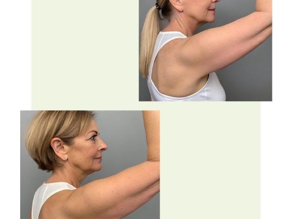 upper-arm-skin-removal-restore-firm-confident-arms