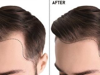 best-hair-plantation-in-uk-natural-results-at-trusted-clinics