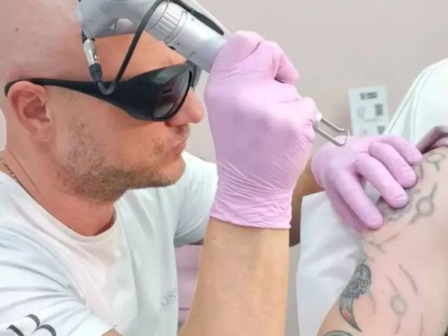 tattoo-removal-cost-in-london-with-free-consultation