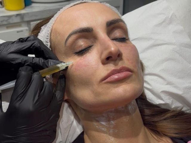 best-platelet-rich-plasma-treatment-for-skin-in-kentish-town
