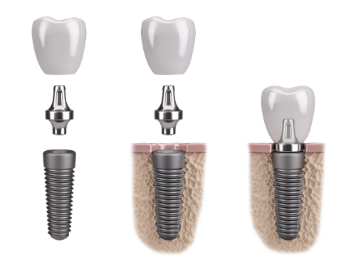 restorative-dentistry-in-bristol-expert-smile-restoration