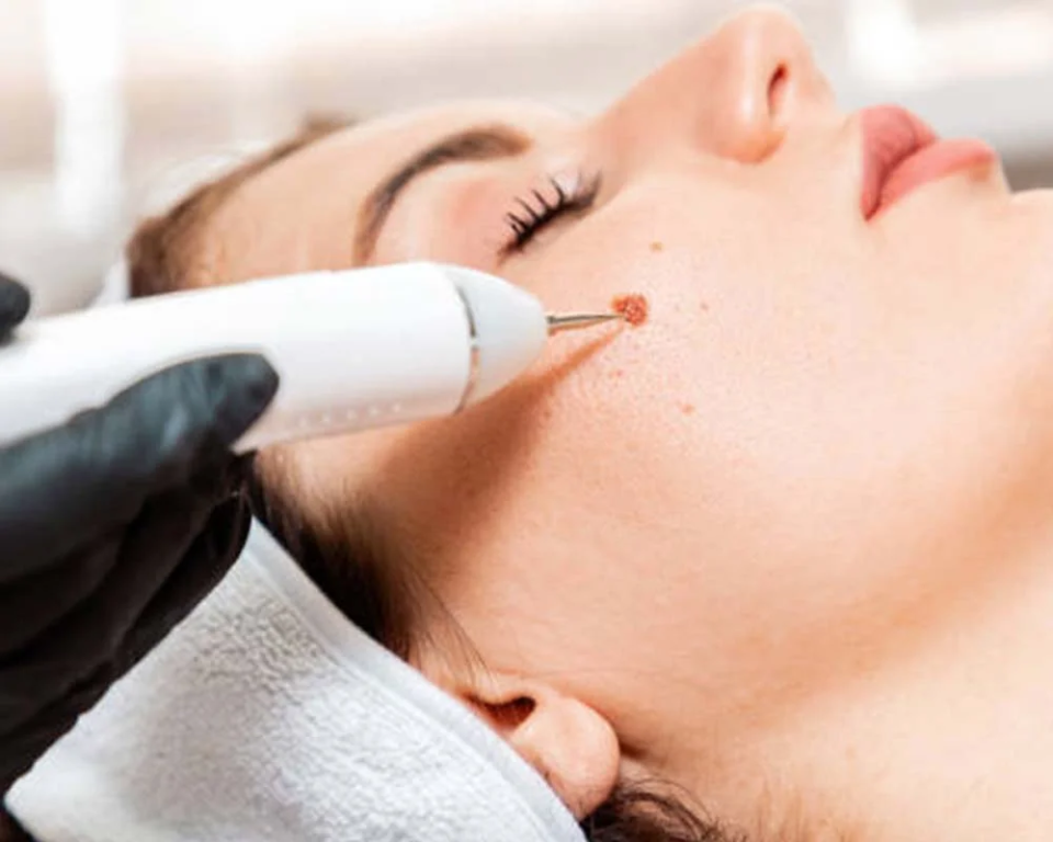 mole-removal-clinic-maidenhead-call-02036330332-big-0