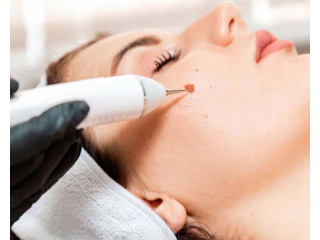 mole-removal-clinic-maidenhead-call-02036330332-small-0