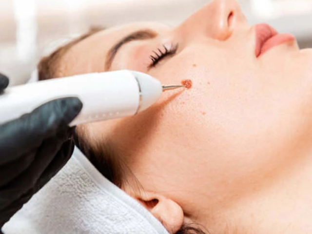mole-removal-clinic-maidenhead-call-02036330332