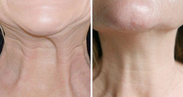 neck-lift-with-suture-suspension-ealing-call-02036330332-big-0