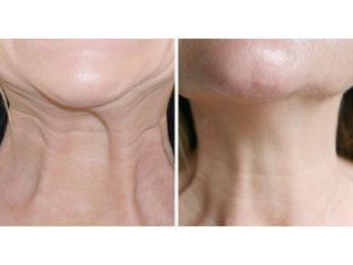 neck-lift-with-suture-suspension-ealing-call-02036330332-small-0